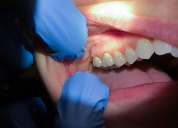Best Emergency Denture Repair in Macopin, NJ